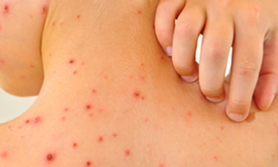 Sốt xuất huyết c&oacute; khả năng b&ugrave;ng ph&aacute;t d&ugrave; kh&ocirc;ng phải năm trong chu kỳ dịch