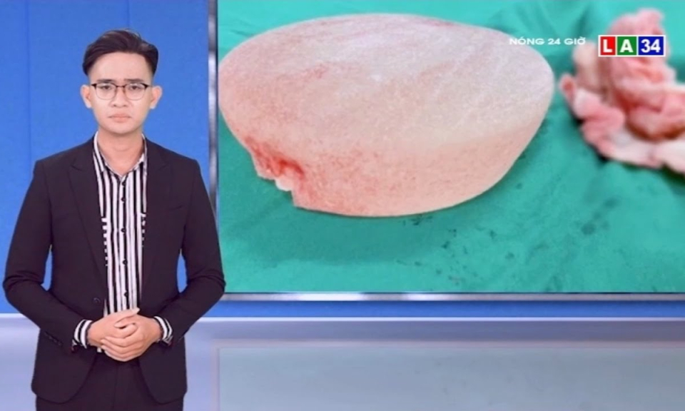 Một nữ bệnh nh&acirc;n bị spa “bỏ qu&ecirc;n” miếng gạc trong ngực g&acirc;y thủng lỗ