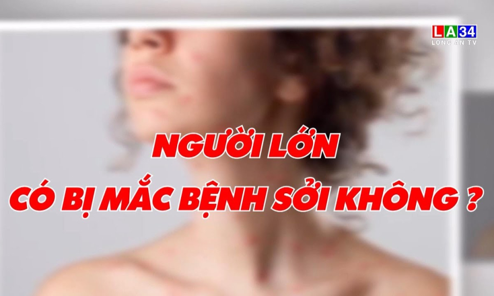 Sức khoẻ & Đời sống: Người lớn c&oacute; mắc bệnh Sởi kh&ocirc;ng?