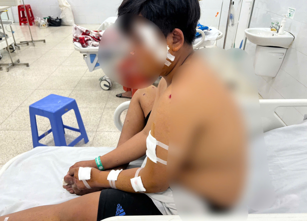 Một trường hợp bị thương do tham gia làm pháo tự chế