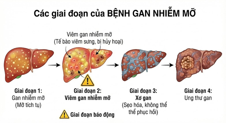 Tại sao người gầy vẫn bị gan nhiễm mỡ?