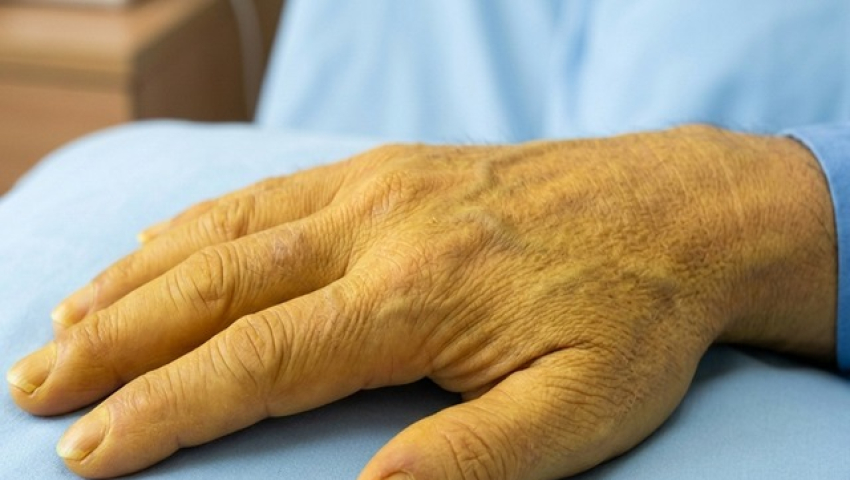 3 biểu hiện ở gan b&aacute;o động nguy cơ đe dọa t&iacute;nh mạng