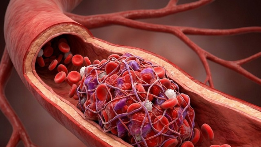 V&igrave; sao tiểu đường lại dễ g&acirc;y đột quỵ?