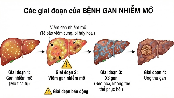 Tại sao người gầy vẫn bị gan nhiễm mỡ?