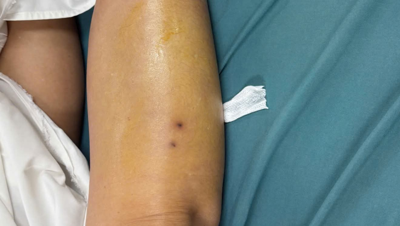 Bệnh viện Đa khoa Long An: Cứu sống bệnh nh&acirc;n bị rắn độc cắn trong t&igrave;nh trạng nguy kịch